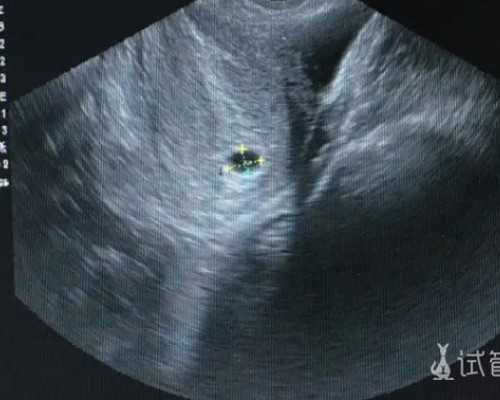 促排卵针疼痛感解析：辅助生殖排卵方案与用药指南